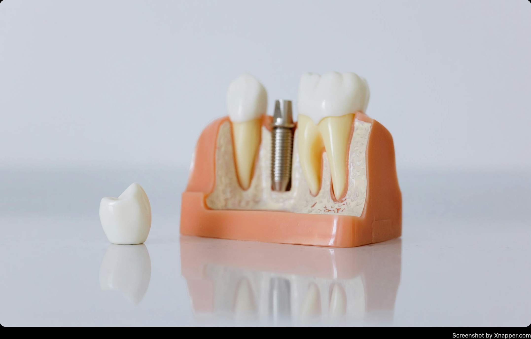 Dental Implants